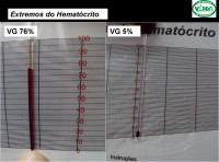 Eritrocitose e anemia